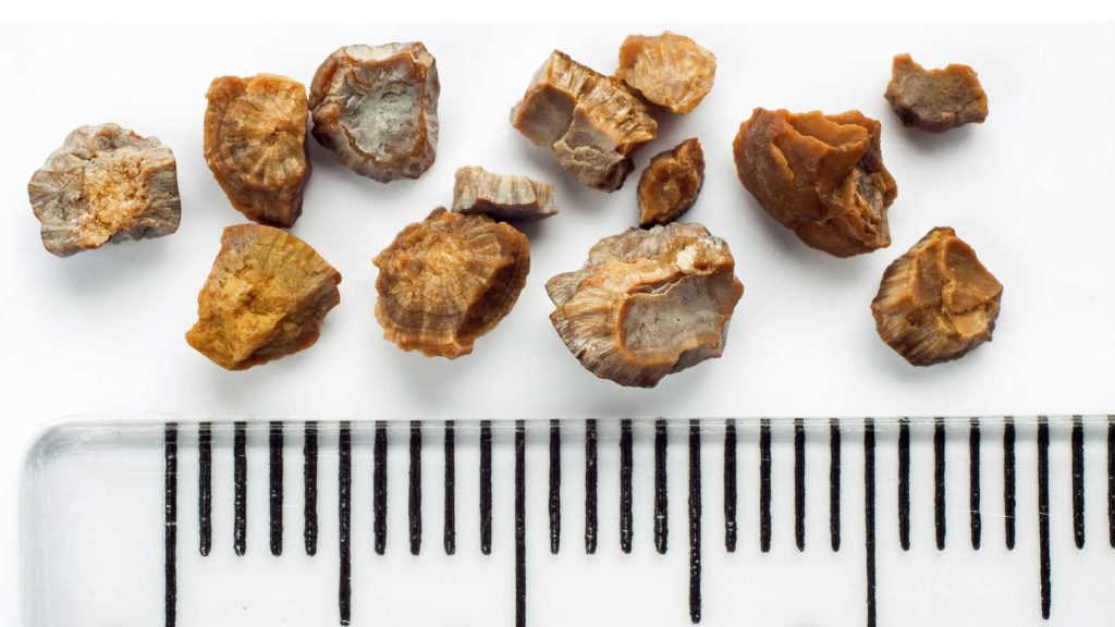 سنگ کلیه چه نشانه‌هایی دارد؟