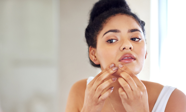 درمان‌های خانگی برای جوش صورت