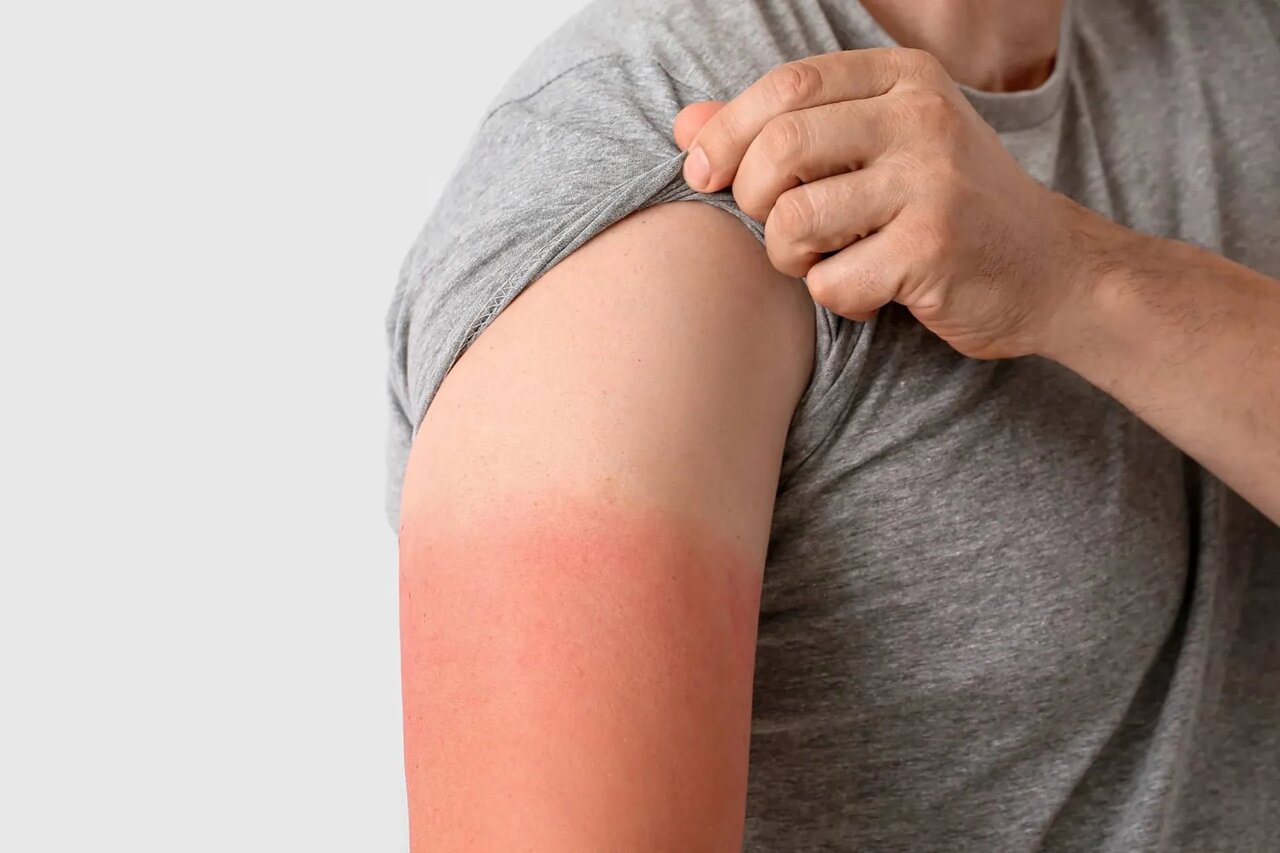 بهبود آفتاب سوختگی